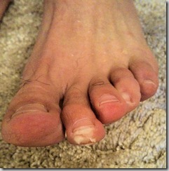 Bad toe